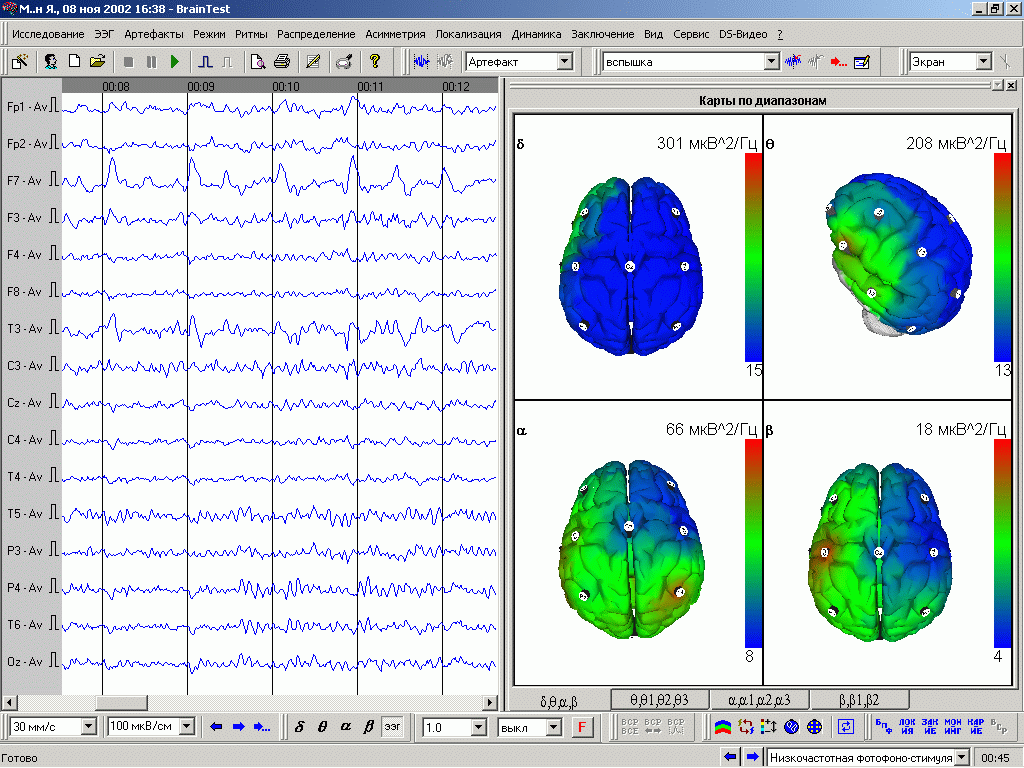 eeg-results-jackson-chiropractor